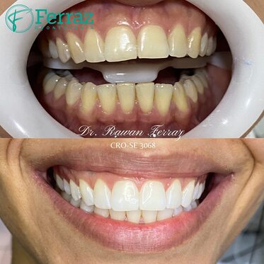 Clareamento dental