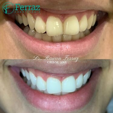 Clareamento dental